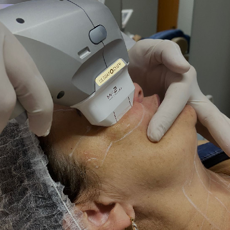 Imagem do procedimento Rejuvenescimento